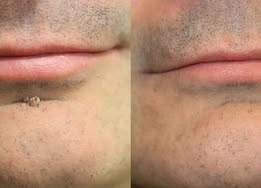 Mightyvra® Microneedle Clear Patches ✨Targets Skin Tags, Acne, Wrinkles & Blemishes
