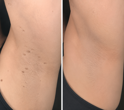 Mightyvra® Microneedle Clear Patches ✨Targets Skin Tags, Acne, Wrinkles & Blemishes