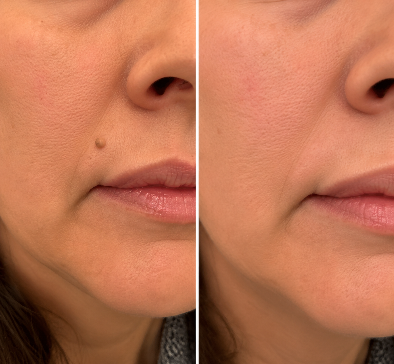 Mightyvra® Microneedle Clear Patches ✨Targets Skin Tags, Acne, Wrinkles & Blemishes