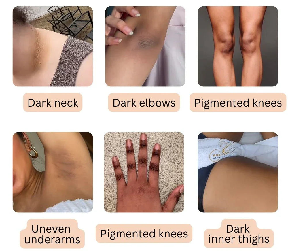 NESLEMY Dark Spot Eraser Spray 🌿 Gentle Peel, Even Tone, Spa Results