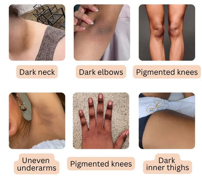 NESLEMY Dark Spot Eraser Spray 🌿 Gentle Peel, Even Tone, Spa Results